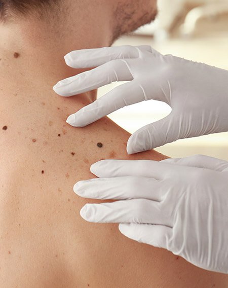 mole removal dr nitin verma medi skin laser clinic